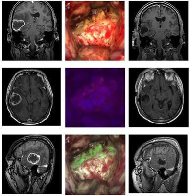 Frontiers 5-Aminolevulinic Acid Multispectral Imaging for the